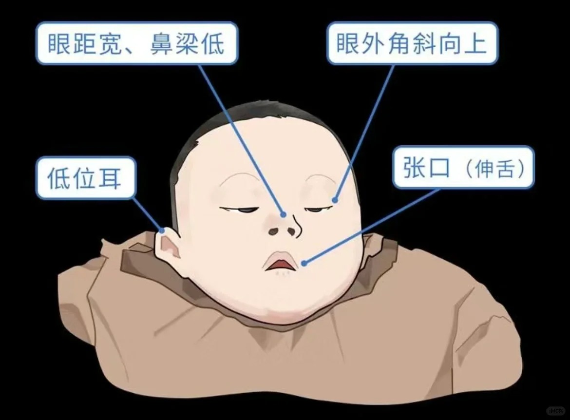 唐氏综合征相关知识